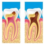 نحوه مبارزه با پوسیدگی دندان | بهترین دندانپزشک اصفهان
