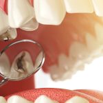 نشانه های سندروم ترک دندان چیست؟ | بهترین دندانپزشک اصفهان