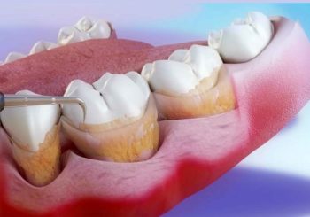نکات مراقبتی مهم بعد از کورتاژ لثه