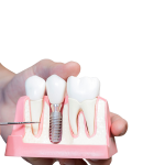 نکاتی پیرامون ایمپلنت دندان | بهترین دندانپزشک اصفهان