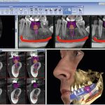 کاربرد انواع ایمپلنت دیجیتال | بهترین دندانپزشک اصفهان