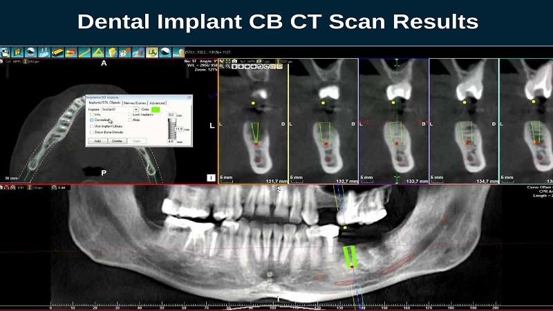 کاربردهای تصویربرداری CBCT برای ایمپلنت دندان | بهترین دندانپزشک اصفهان