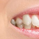 روش های صاف کردن دندان کج (قسمت دوم) | بهترین دندانپزشک اصفهان